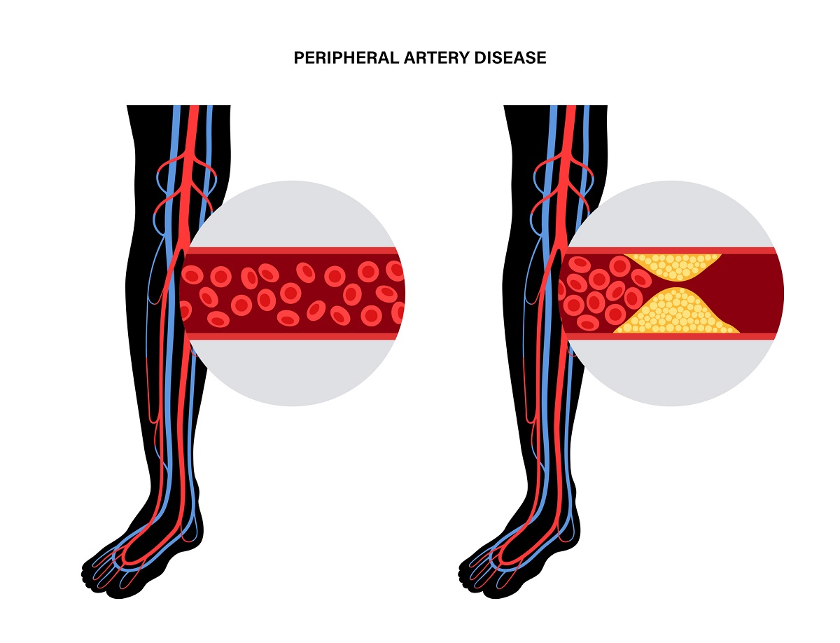 two legs: one showing good blood flow and one showing partial blockage